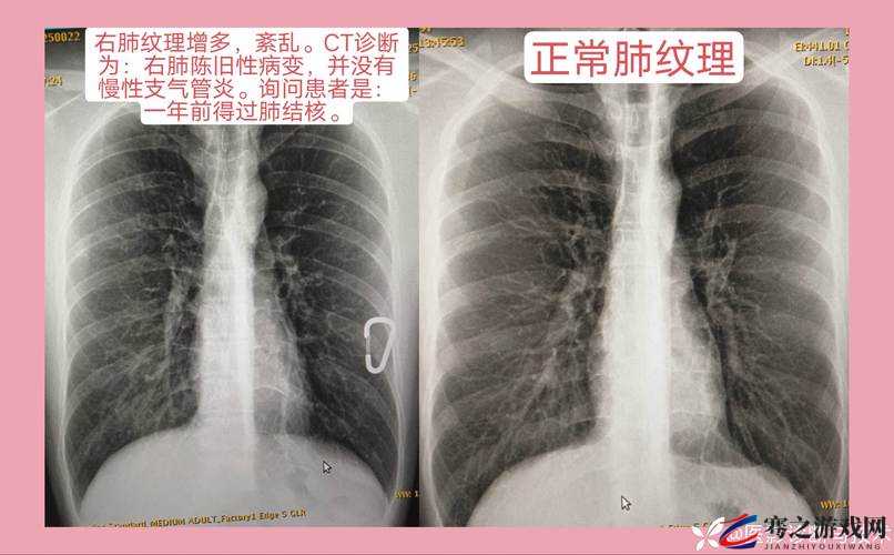 100%胸片曝光：深度剖析其在医疗诊断中的关键作用